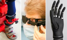 Split image (left to right) shows: a child's leg walking with a bionic exoskeleton, bionic eye transplant, and an innovative prosthetic hand